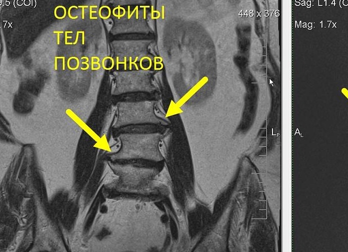 ОСТЕОФИТЫ НА МРТ ПОЗВОНОЧНИКА