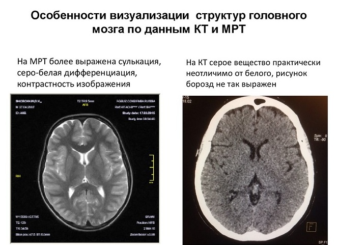 ЧЕМ МРТ ОТЛИЧАЕТСЯ ОТ КТ И ЧТО ИЗ НИХ ЛУЧШЕ?