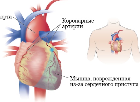 Сердце бьется слишком быстро? 5 причин тахикардии
