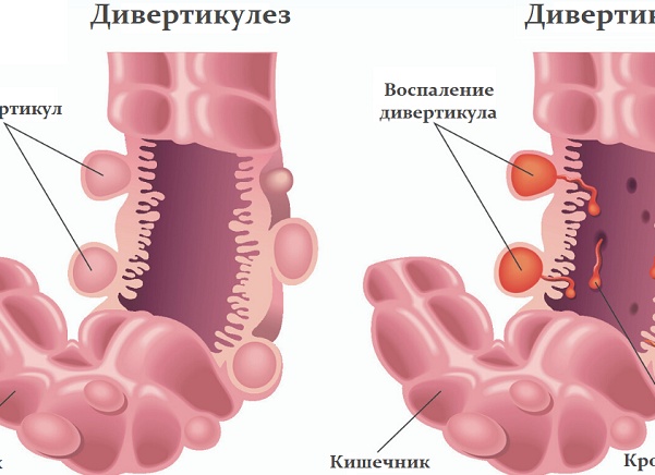 Дивертикулит кишечника: симптомы, диагностика, лечение