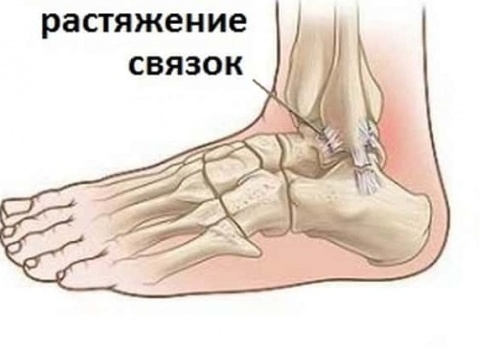 Как лечить высокое растяжение связок голеностопа