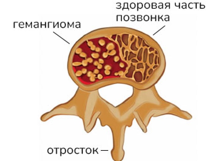Гемангиома позвонка: как лечить?