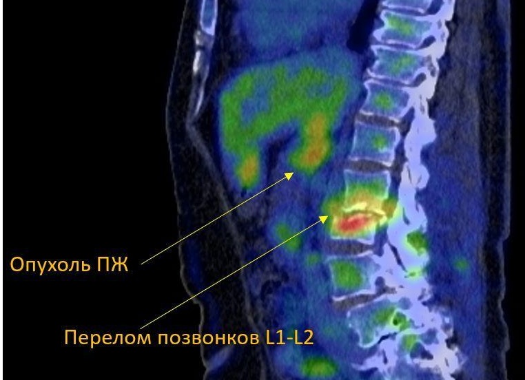 Позитронно-эмиссионная томография, совмещенная с компьютерной томографией: мифы и правда