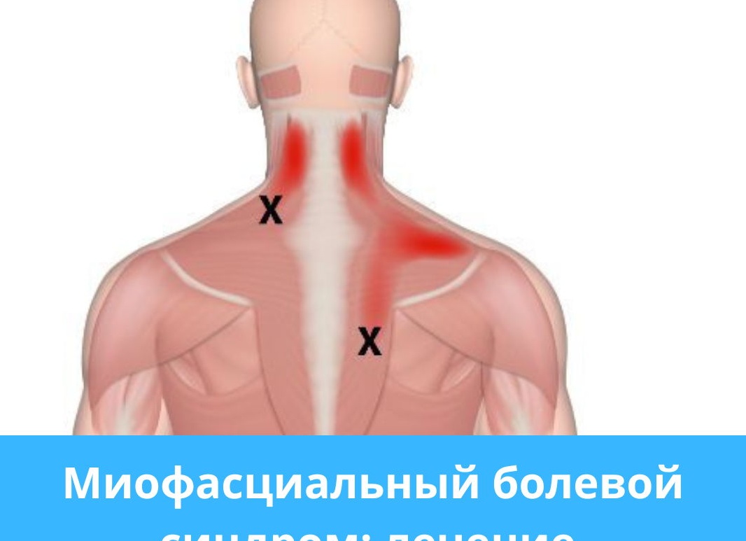 МИОФАСЦИАЛЬНЫЙ БОЛЕВОЙ СИНДРОМ (МФБС) Диагностика и лечение