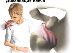 Лечение нестабильности плечевого сустава