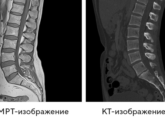 Что показывает КТ позвоночника